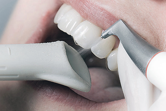 A fogkő eltávolítása egészségügyi szempontból is meghatározó.